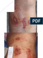 Invasive Systemic Staph Healed Without Antibiotics