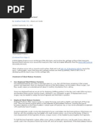 Tibial Plateau Fracture