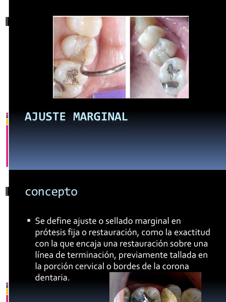 Ajuste Marginal | Diente humano | Dentadura postiza | Prueba gratuita ...