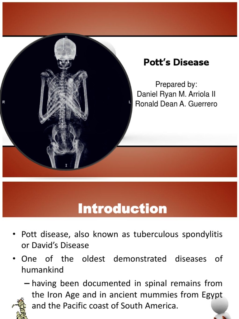 Pott's Disease Vertebral Column Spinal Cord