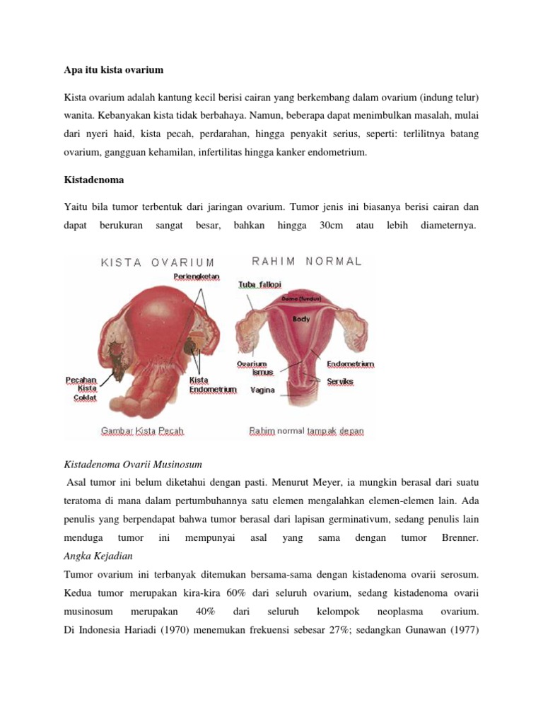 Apa Itu Kista Ovarium PDF