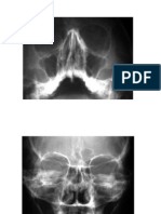 Senos Paranasales