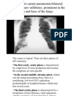 Pneumocystis Carinii Pneumonia-Bilateral, Fluffy Pulmonary Infiltrates, Prominent in The Hilum and Base of The Lungs