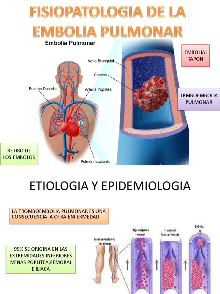Embolia Pulmonar | PDF | Ciencia y matemáticas