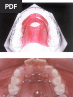 Clase 1 Aparatos Removibles Parte III