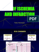 ECG, Ischemia, MCI (Rev)