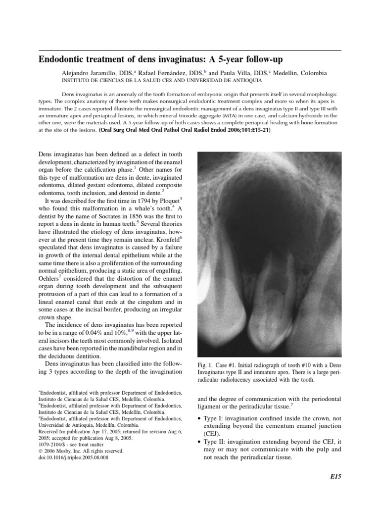 Endodontic Treatment of Dens Invaginatus PDF Dental Anatomy Medicine