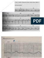 Ekg Normal