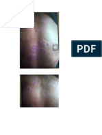 Gambar Psoriasis