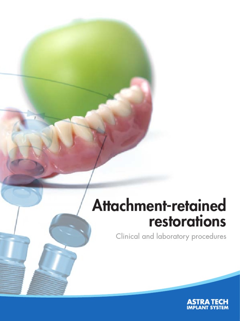 AttachmentRetained Restorations Dental Implant Dentures