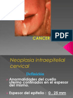 Cancer in Situ de Cervix Unu