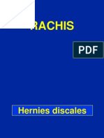 2- Hernies discales