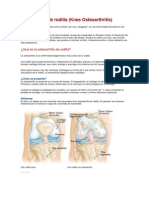 Osteoartritis de Rodilla