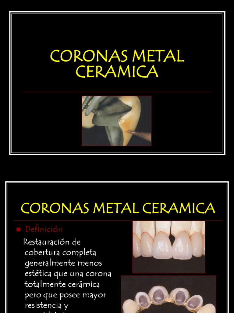 Corona de metal-cerámica. Materiales, Precio, Ventajas y desventajas