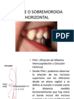 Resalte o Sobremordida Horizontal