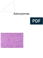 Astrocytomas