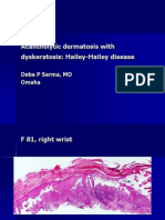 Acantholytic Dermatosis With Dyskeratosis. F 81, Right Wrist