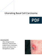 Ulcerating Basal Cell Carcinoma