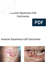 Invasive Squamous Cell Carcinoma