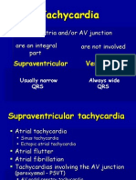 Tachycardia