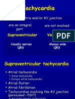 Types of Tachycardia: Supraventricular vs Ventricular