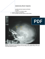 Biotelemetry Brain Implants