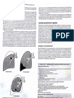 EDEMA PULMONAR (Patologia Estructural y Funcional, 7_ Ed. Robbins y Cotran