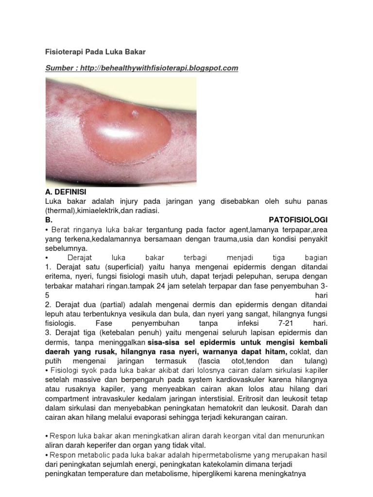 Fisioterapi Pada Luka Bakar