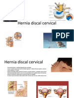 Hernia Discal Cervical