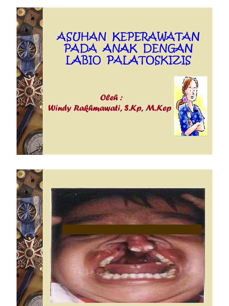 Asuhan Keperawatan pada Palatoskizis | PDF