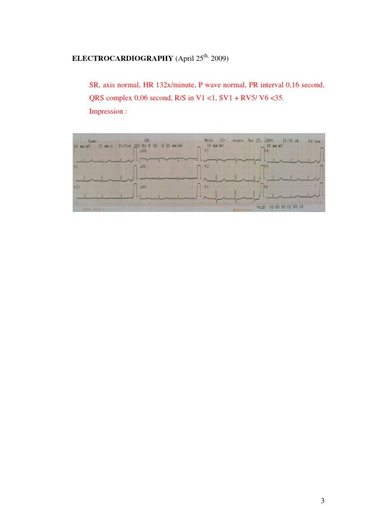 RV5/SV1 Analysis in ECG Report | PDF