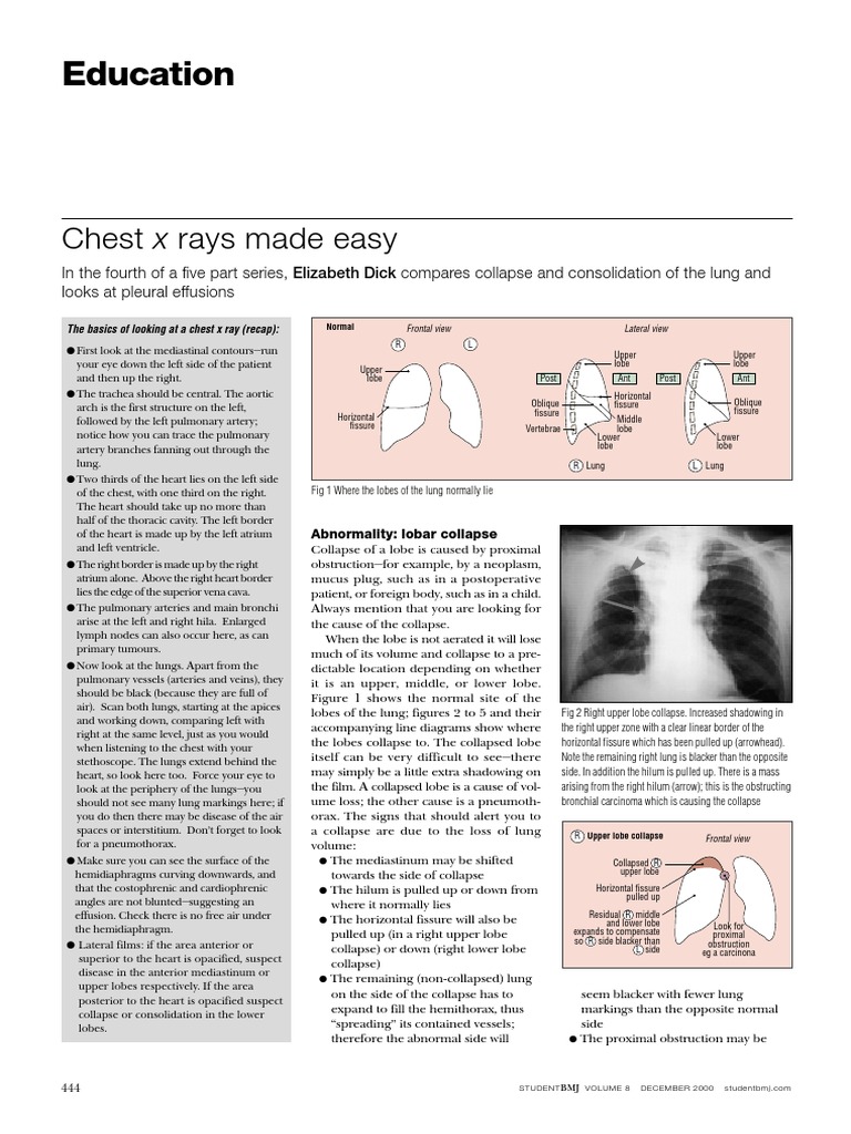 How To Read Chest X Ray PDF Lung Thorax