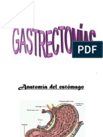 Gastrectomia Bilroth II