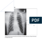 Open Pneumothorak