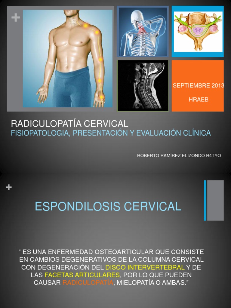 Radiculopatía | PDF | Electromiografia | Enfermedades y trastornos