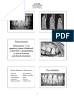 Periodontitis mantap