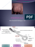 HIDROCELE