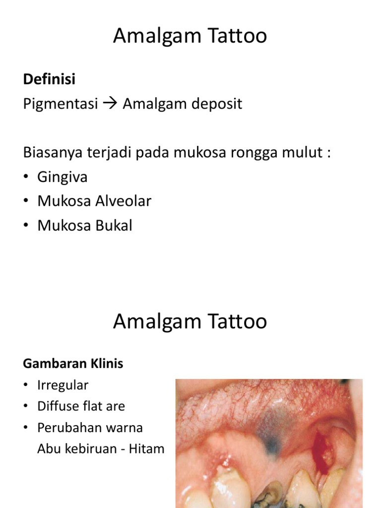 Amalgam Tattoo PDF