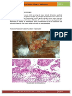 El Cistoadenoma Seroso de Ovario