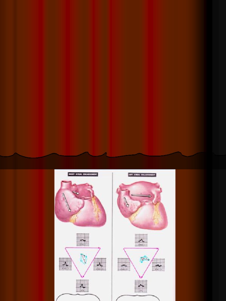 Rah, Lah, RVH, LVHK | PDF | Electrocardiography | Cardiovascular Diseases
