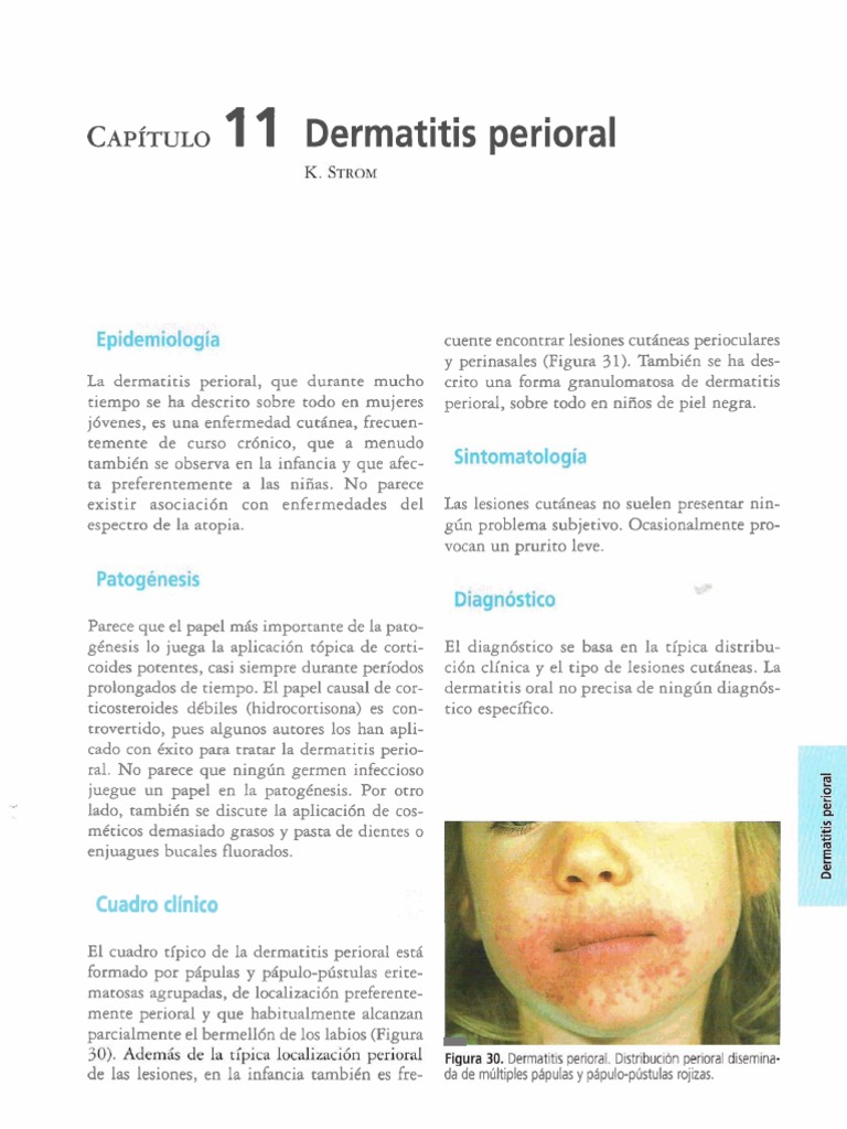 Dermatitis Peri Oral | PDF | Especialidades Medicas | Enfermedades y ...