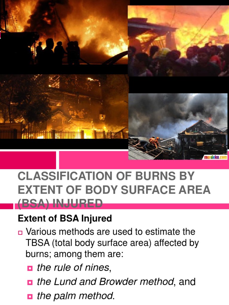 burn.ppt Burn Shock (Circulatory)