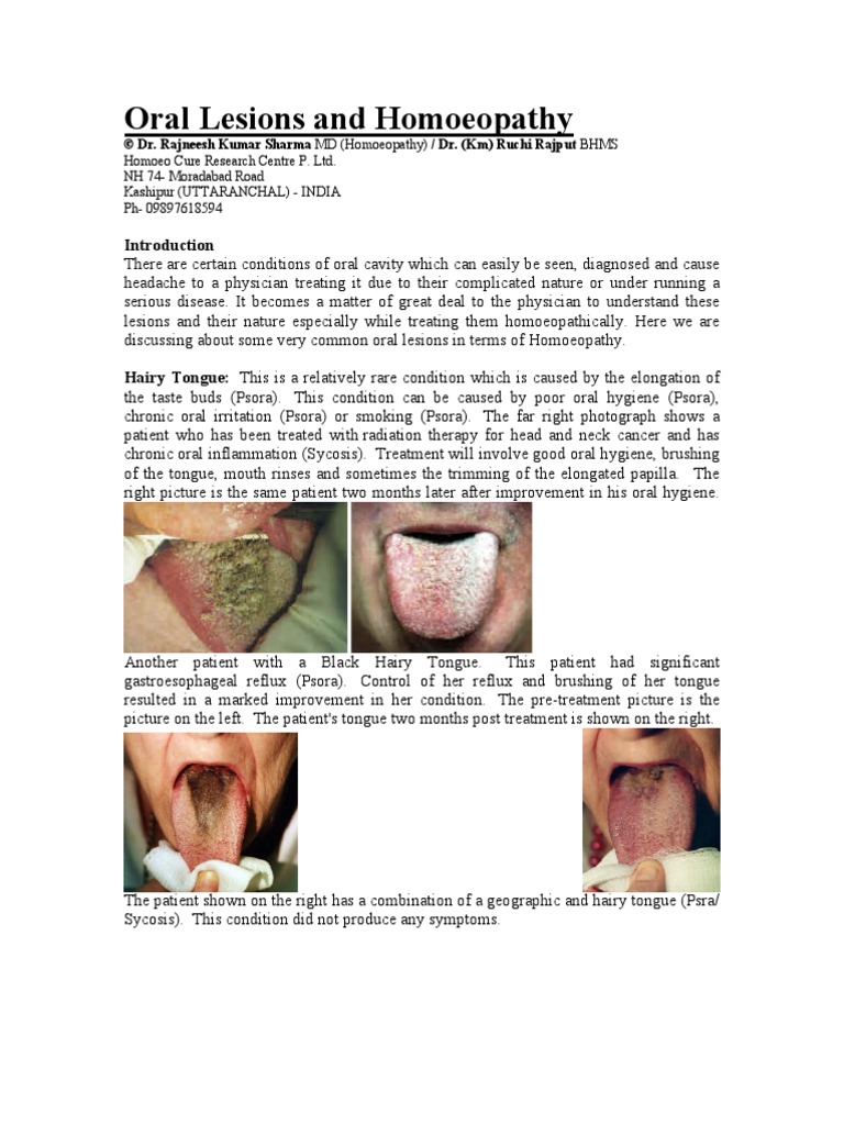Tongue Lesions and Homoeopathy Carcinoma Tongue