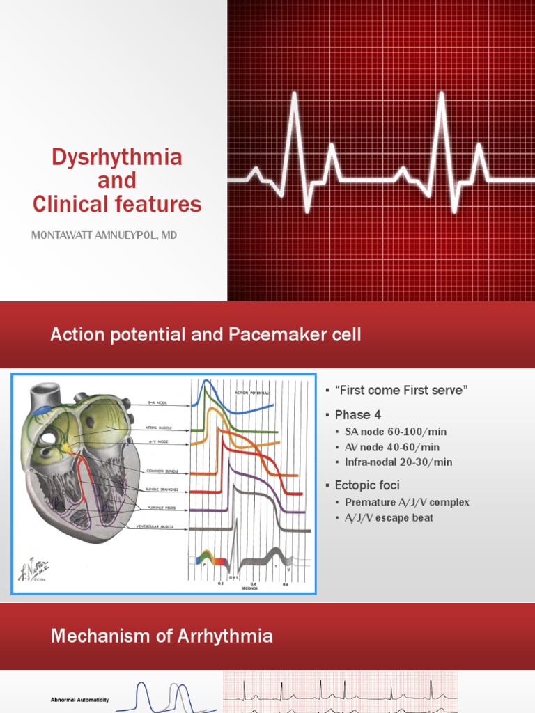 Dysrhythmia Cardiac Arrhythmia Cardiac Electrophysiology