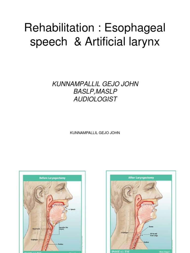 Esophageal Speech & Artificial Larynx Guide | PDF | Esophagus | Larynx