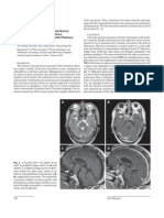 A Giant Intracavernous Carotid Artery