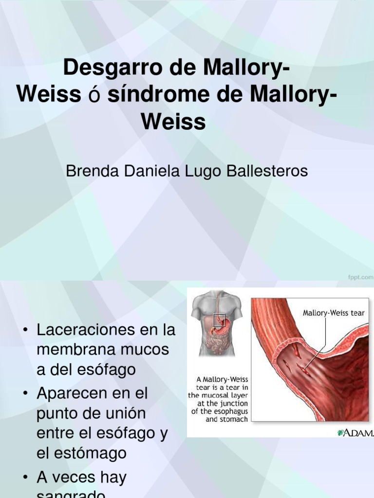 Desgarro de Mallory-Weiss | PDF