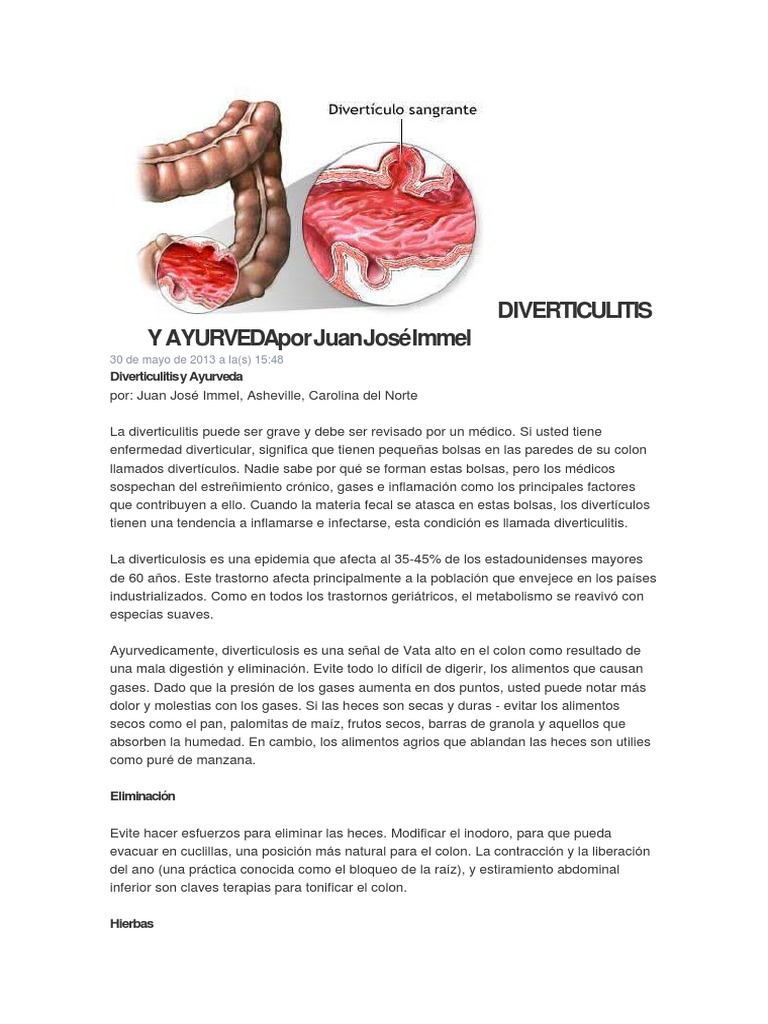 DIVERTICULITIS Y AYURVEDA Por Juan José Immel PDF Heces Estreñimiento
