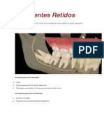 Dentes Retidos (Classificações)