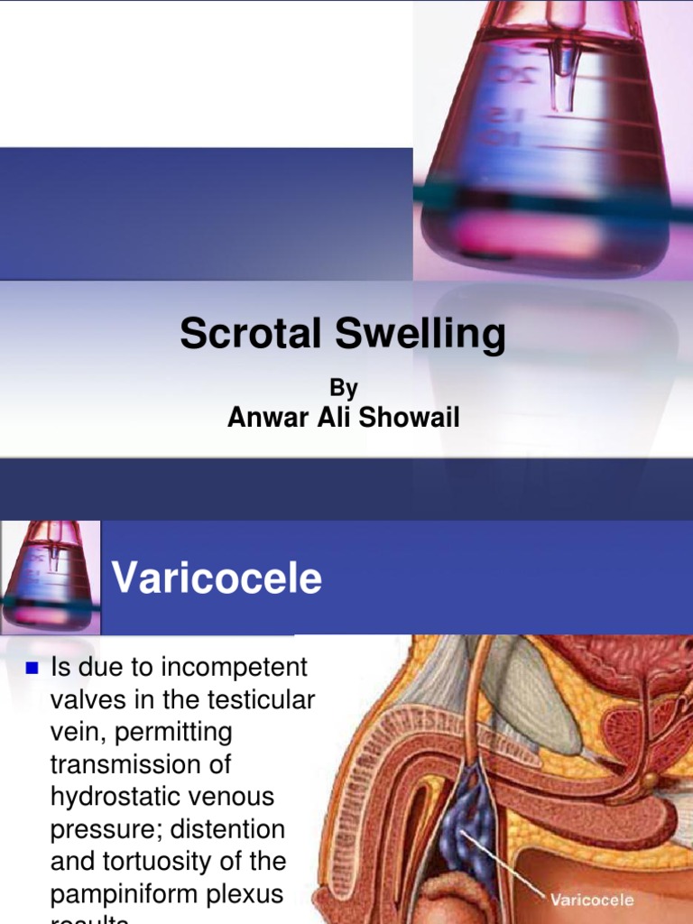 Scrotal Swelling2 Neoplasms Health Sciences